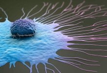 خلية سرطان الثدي